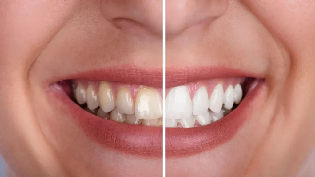 whiten teeth